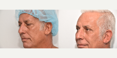 Eyelid Surgery before and after photo