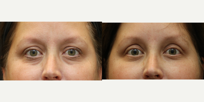 Eyelid Surgery before and after photo