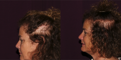 Kybella before and after photo