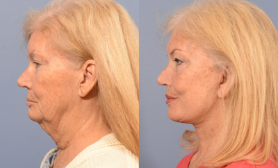 Neck Lift before and after photo
