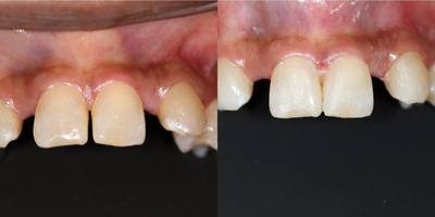 Dental Bonding before and after photo