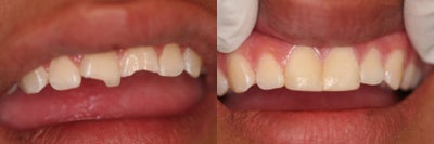 Dental Bonding before and after photo