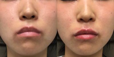 Dermal Fillers before and after photo