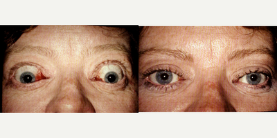 Eyelid Retraction Repair before and after photo