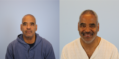Hair Transplant before and after photo