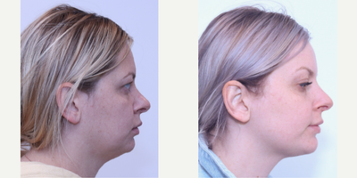Brow Lift before and after photo