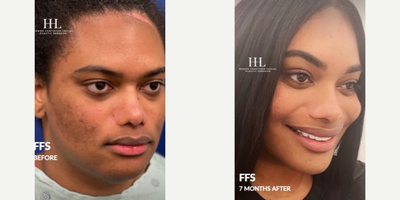 Cheek Augmentation before and after photo
