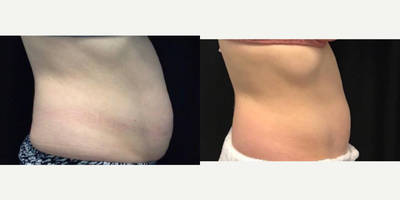CoolSculpting before and after photo