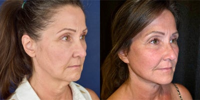 Deep Plane Facelift before and after photo