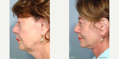 Facelift before and after photo