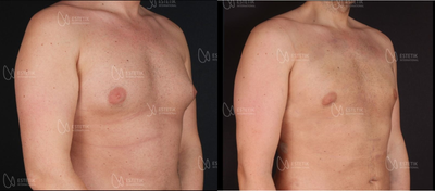 Gynecomastia Surgery before and after photo