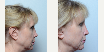 Juvederm before and after photo