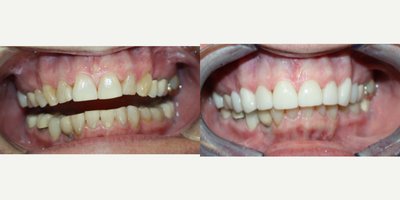 Lumineers before and after photo