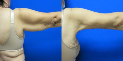 Arm Lift before and after photo