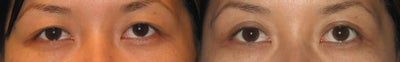 Double Eyelid Surgery before and after photo