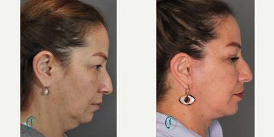 Eyelid Surgery before and after photo