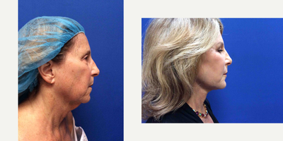 Facelift before and after photo
