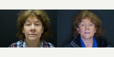 Facelift before and after photo