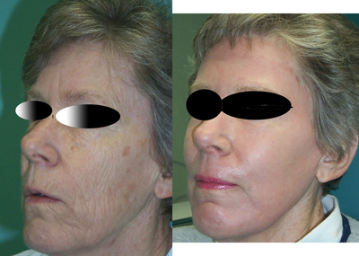 Laser Resurfacing before and after photo