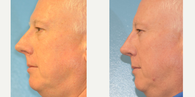 Rhinoplasty before and after photo