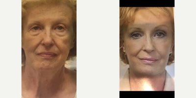 Skin Rejuvenation before and after photo