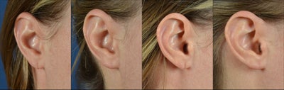 Earlobe Repair before and after photo