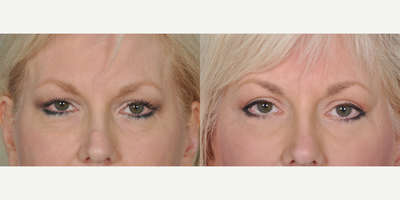 Eyelid Surgery before and after photo
