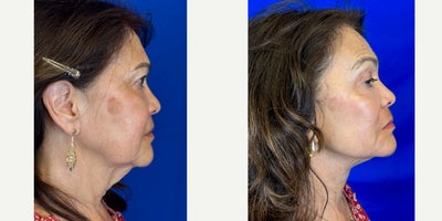 Eyelid Surgery before and after photo