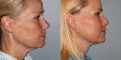 Facelift before and after photo