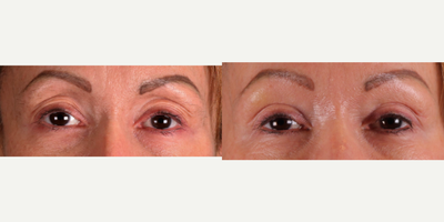 Facelift before and after photo