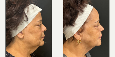 FaceTite before and after photo