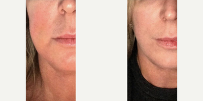Kybella before and after photo