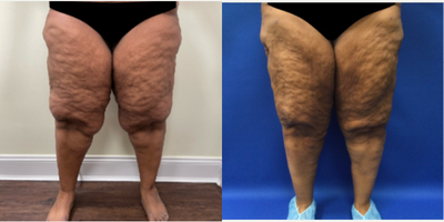 Lipedema Surgery before and after photo