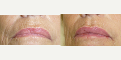 Restylane Silk before and after photo