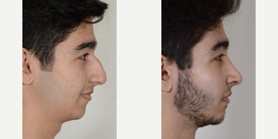 Rhinoplasty before and after photo