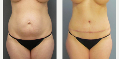 Tummy Tuck before and after photo