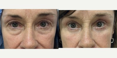Eyelid Surgery before and after photo