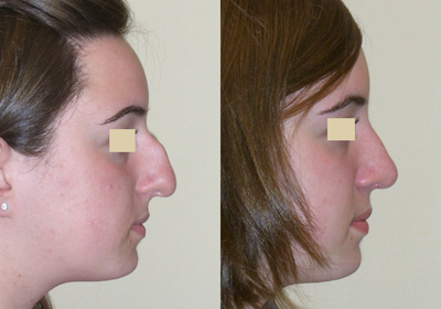 Rhinoplasty before and after photo