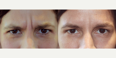 Botox before and after photo