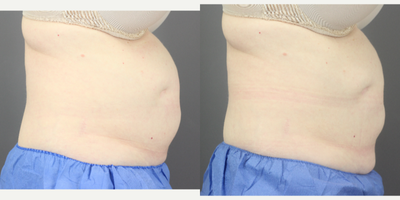 CoolSculpting before and after photo