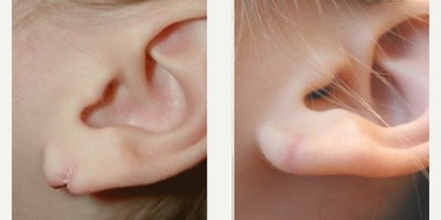 Earlobe Repair before and after photo