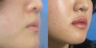 Lip Fillers before and after photo