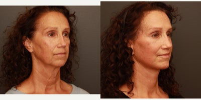 Lip Lift before and after photo