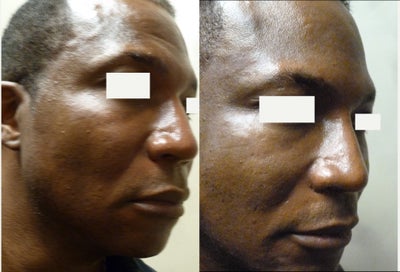 Nonsurgical Nose Job before and after photo