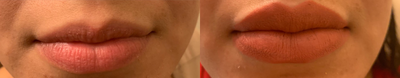 Restylane Defyne before and after photo