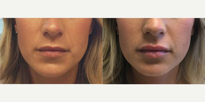 Voluma before and after photo