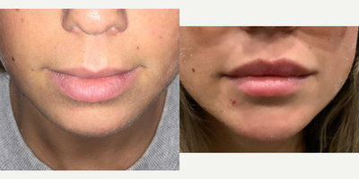 Belotero before and after photo
