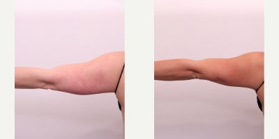 CoolSculpting Elite before and after photo