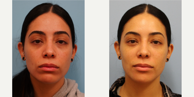 Dermal Fillers before and after photo