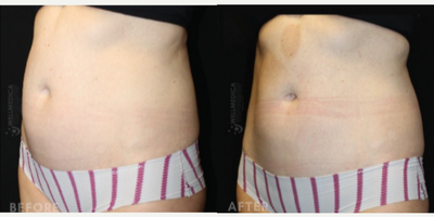Emsculpt before and after photo